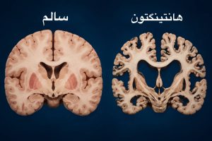 چرا کاردرمانی در بیماری هانتینگتون اهمیت دارد؟